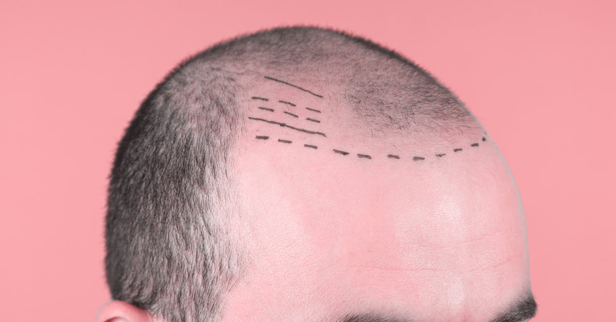 IS A HAIR TRANSPLANT PAINFUL?