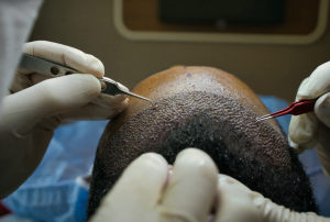smart graft hair transplant maxim restoration
