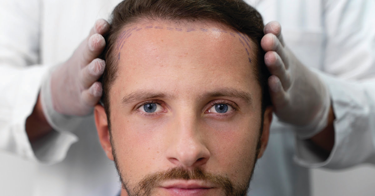 FACTS ABOUT HOW YOUR HAIR WILL LOOK AFTER HAIR TRANSPLANT SURGERY