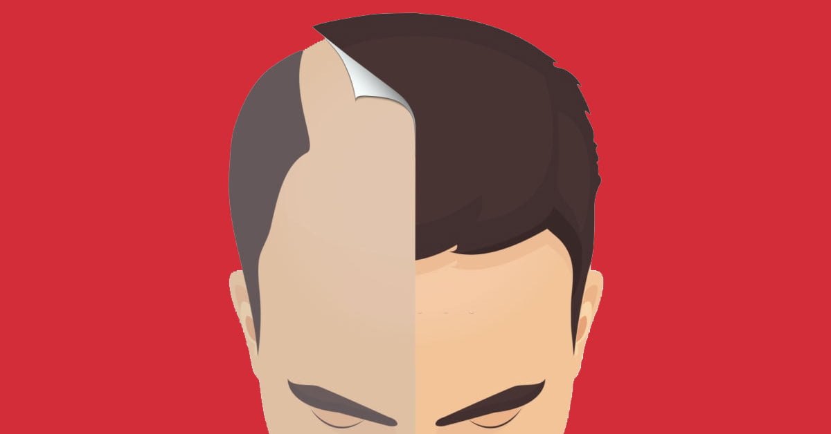 Hair transplants: How they Work