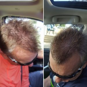 man with hair regrowth
