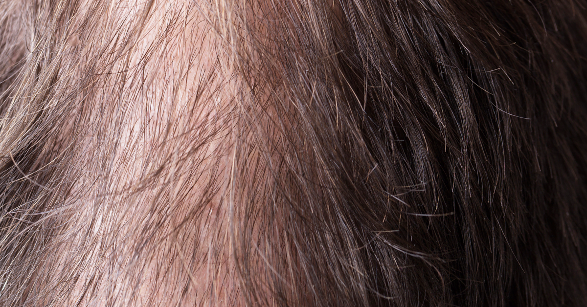 WHAT IS HAIR REGROWTH?