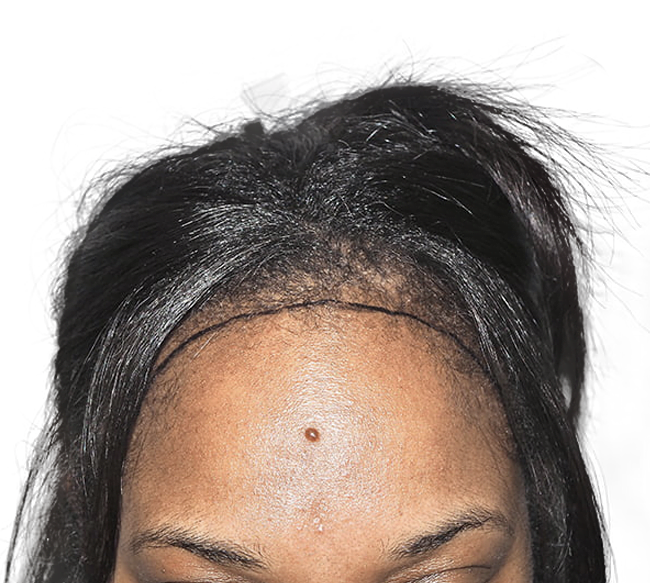 African American Hair Transplant