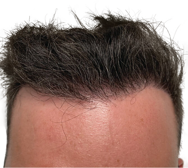 FUE Hair Transplants in Fort Worth, TX