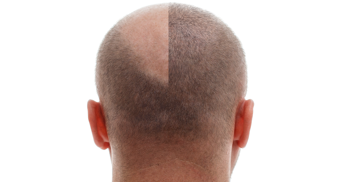 WHAT TO EXPECT WITH A CROWN HAIR TRANSPLANT