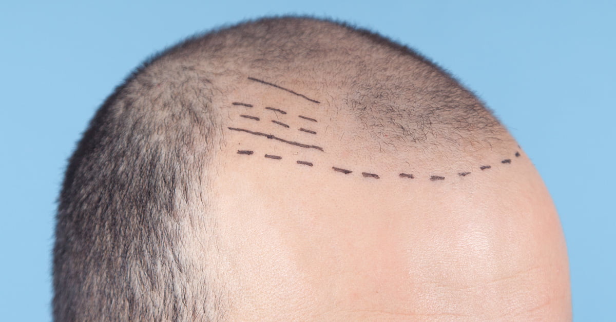WHAT IS THE BEST FUE METHOD?