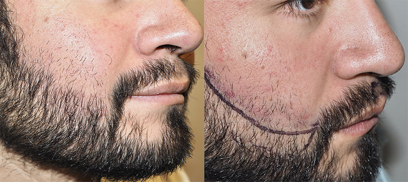 Facial Hair Transplant | Facial Hair Restoration | MAXIM Hair Restoration