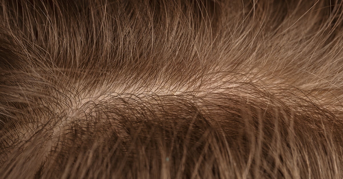 DOES FASTING CAUSE HAIR LOSS?