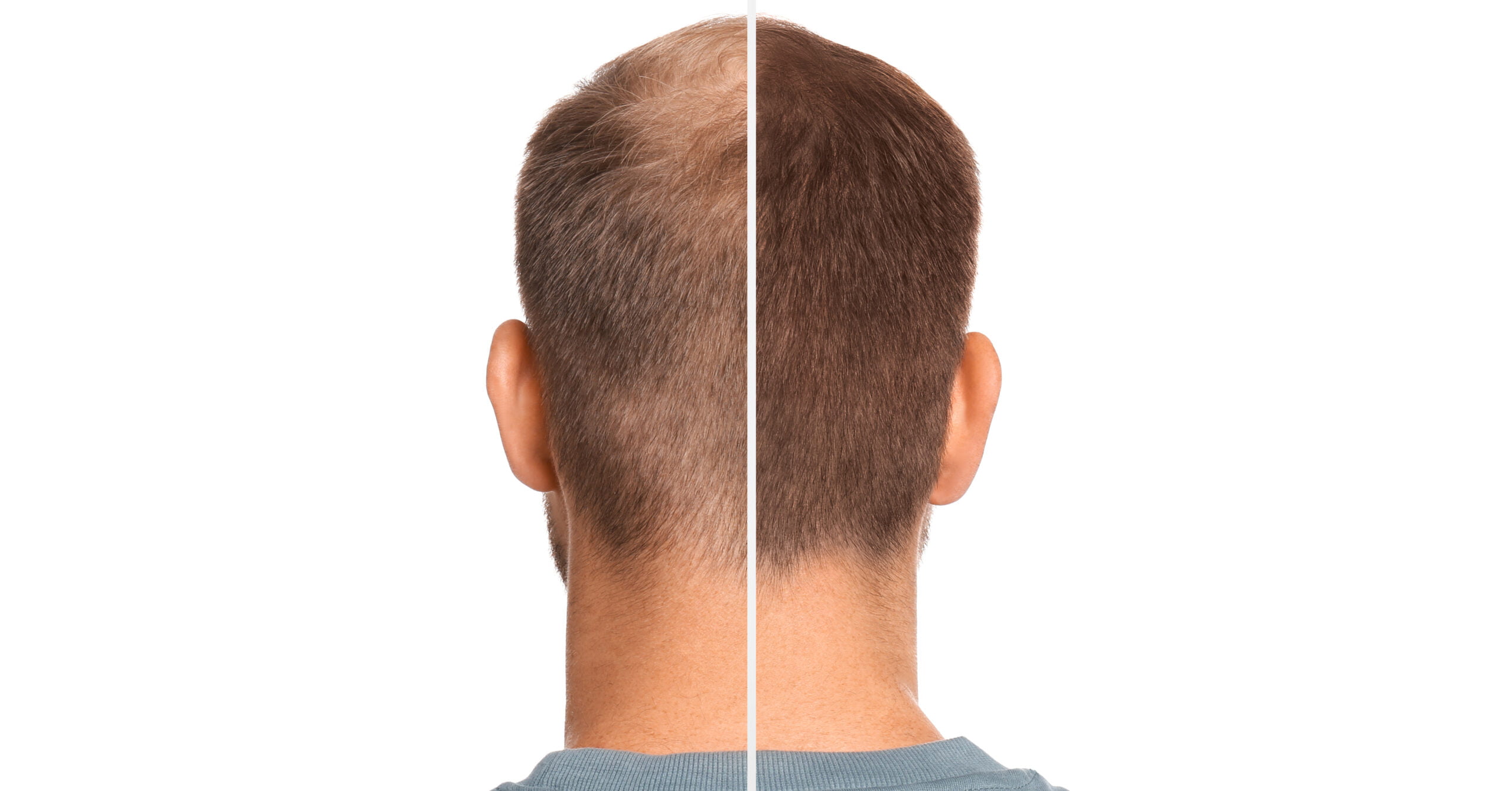 UNVEILING 10 INTRIGUING FACTS ABOUT HAIR TRANSPLANTS THAT WILL SURPRISE YOU