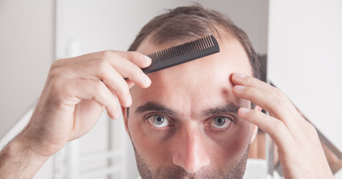 UNDERSTANDING MALE PATTERN BALDNESS: CAUSES, INDICATORS, AND PREVENTION