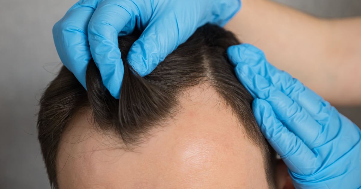 THE IMPACT OF DONOR GRAFTS ORIGIN ON HAIRLINE RESTORATION: A COMPREHENSIVE ANALYSIS
