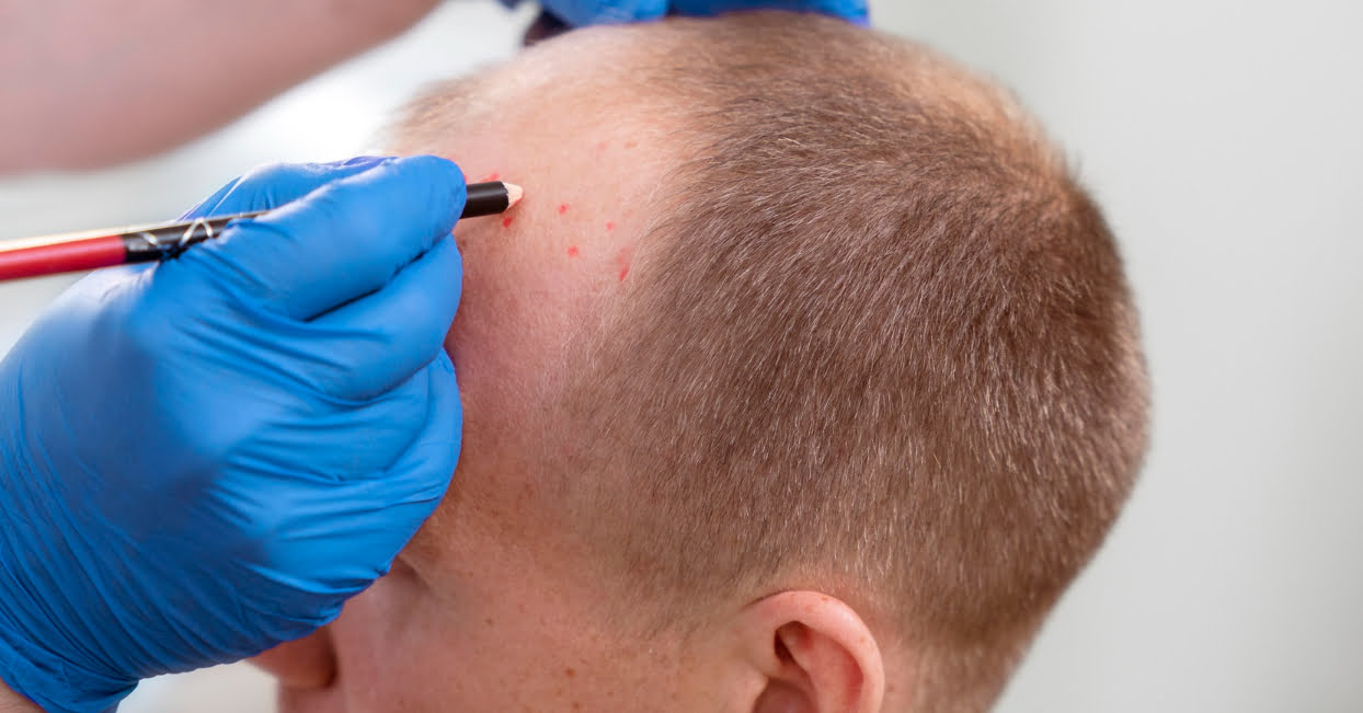STRATEGIZING YOUR HAIR TRANSPLANT: FOCUSING ON THE FRONT AND CROWN AREAS
