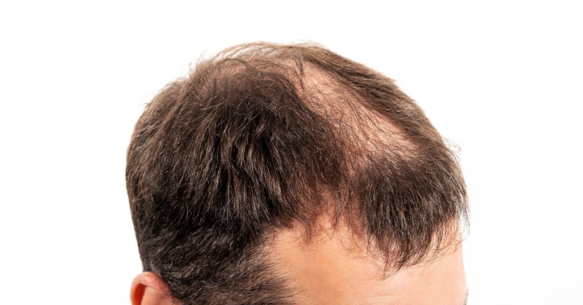 DEALING WITH HAIR LOSS: UNDERSTANDING COMMON AREAS OF CONCERN FOR MEN